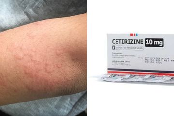 Obat biduran memiliki sifat antihistamin yang dapat membantu meredakan gejala.