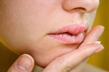 Bengkak dan Biduran di Bibir, Apa Penyebab Utamanya? Simak Disini
