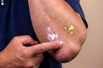 Salep antibiotik dapat digunakan sebagai antibiotik untuk luka.