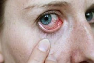Penyebab Mata Perih dan Terasa Panas, Ini Pilihan Obat untuk Mengatasinya