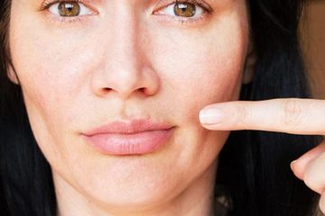 Penyebab dan Arti Muncul Jerawat di Atas Bibir, Sudah Tahu Belum?