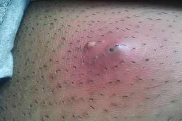 Antibiotik yang Tepat untuk Mengatasi Bisul, Cara Mengobatinya di Rumah Sebelum Parah