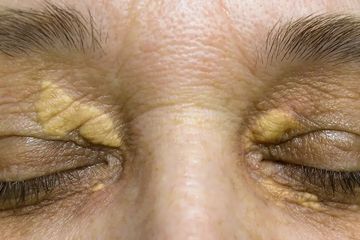 Inilah salah satu tanda kolesterol tinggi yang dapat dilihat dari kulit bagian mata,  disebut  Xanthelasma.