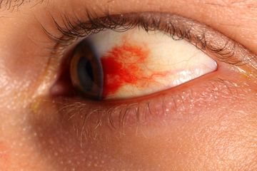 Ketahui 8 Jenis Penyakit Mata yang Paling Berbahaya, Penting Deteksi Dini!  - Semua Halaman - Grid Health