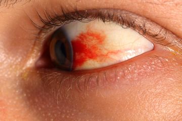 Inilah bentuk retinopati diabetik, salah satu penyakit mata yang paling berbahaya, kenali penyakit lainnya.
