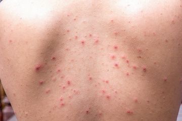 Berikut ini beberapa rekomendasi obat jerawat punggung yang bisa atasi masalah kulit 