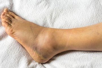 Semudah ini Cara Mengatasi Kaki Bengkak Saat Kadar Asam Urat Tinggi