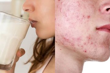 Hormon yang ada pada susu disebut dapat menyebablan inflamasi pada tubuh yang pada akhirnya menyebabkan kulit berjerawat.