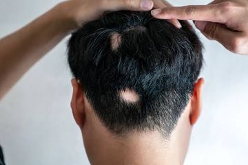 Alopecia Penyakit Autoimun yang Sebabkan Rambut Rontok Seperti Ini