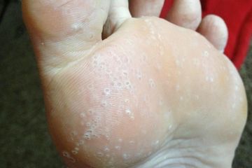 Ini Ciri dan Penyebab Kutu Air yang Membuat Telapak Kaki Bolong-bolong