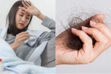 Rambut rontok setelah demam disebut telogen effluvium.