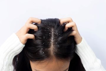 Inilah penyebab muncul ketombe di kulit kepala, yang buat gatal tak tertahankan.