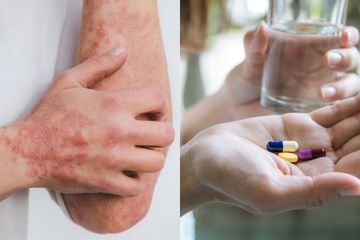 Selain dengan salep, kurap bisa diobati dengan obat oral yang diminum berikut ini.