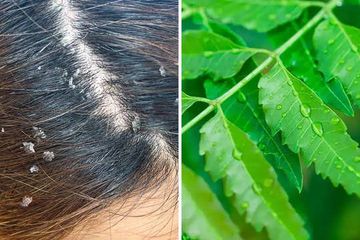 Cara Efektif Menghilangkan Ketombe Membandel, Cukup dengan 3 Daun Ini!