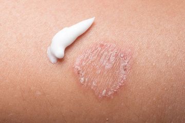 Jangan biarkan dan menjadi parah, berikut ini rekomendasi salep kurap yang ampuh