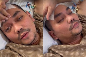 Kondisi terkini Indra Bekti setelah menjalani operasi pendarahan otak