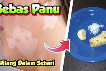 Lengkuas hilangkan panu sampai ke akar.