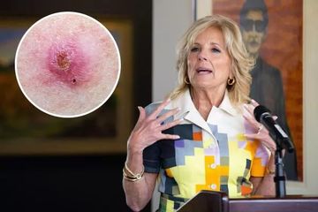 Ibu Negara Amerika Jill Biden Jalani 2 Operasi Kanker Kulit, Kenali Apa Itu Karsinoma Sel Basal dan Operasi Mohs?