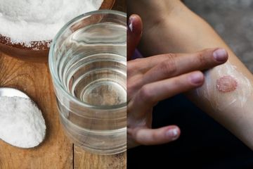 Cara Mengobati Kurap dengan Air Garam, Pengobatan Ampuh Ala Rumahan