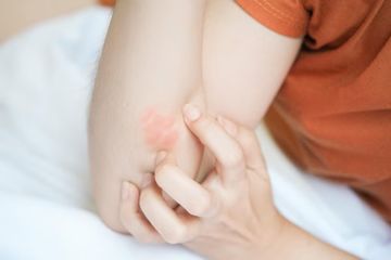 Jangan dibiarkan, inilah obat kurap medis dan non medis yang ampuh