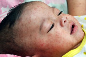 1 Pasien Campak Bisa Menulari 10 Orang Sekaligus yang Ada di Sekitarnya
