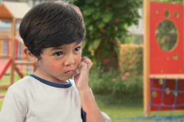 Anak Alergi Susu Sapi? Ini Solusi Agar Kebutuhan Nutrisi Anak Tetap Terpenuhi