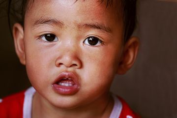 Segera diobati, inilah gejala dan cara mengobati panu pada anak