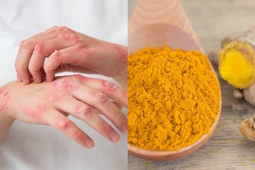 Kunyit termasuk bahan alami yang efektif untuk mengatasi kurap.