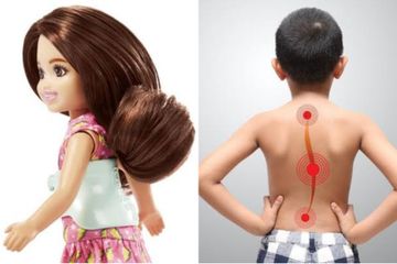 Chelsea Boneka Barbie Skoliosis, Kondisi Apa Itu Sebenarnya?