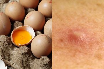 Benarkah makan telur bisa sebabkan bisul?