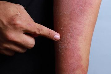 Infeksi jenis jamur kulit umumnya ditandai dengan bercak yang gatal.
