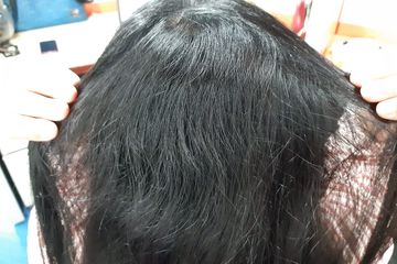 Umur 17 Tahun Ada uban, Apakah Normal? Ini Penjelasannya