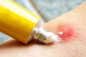 Rekomendasi Salep Penghilang Bekas Luka di Kaki Akibat Gigitan Nyamuk