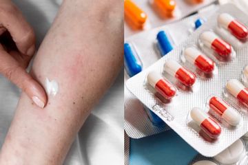 Rekomendasi Obat Kurap Mulai dari Krim Salep Hingga Obat yang Diminum