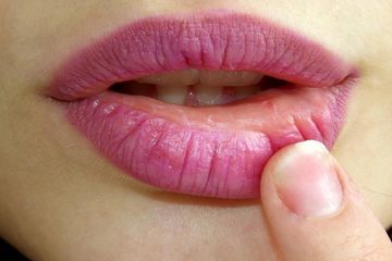 Cara Mencegah Bibir Tergigit Supaya Tidak Menjadi Sariawan