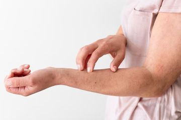 Masalah pada kulit merupakan salah satu komplikasi OCD akibat sering mencuci tangan.