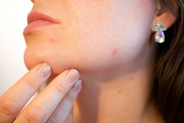 Murah dan Mudah, Ini 6 Bahan Alami untuk Hilangkan Bekas Jerawat