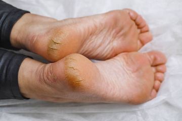 Mengatasi Kaki Pecah-pecah dengan Minyak Zaitun, Hasilnya Langsung Terlihat dalam Semalam