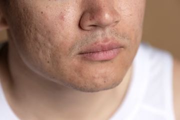 Menghilangkan bopeng di kulit dengan bahan alami 