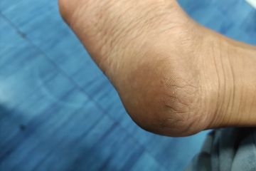 5 Trik Menghaluskan Kaki Pecah-pecah, Hasilnya Cepat Terlihat