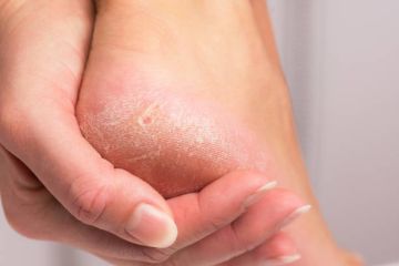Cara mengatasi kaki kapalan di rumah.