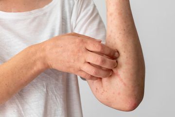 Kasus Monkeypox Kembali Melonjak, Kenali Gejala dan Penyebabnya