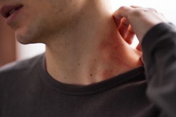 Area kulit terbuka seperti leher, sering digigit kutu busuk.