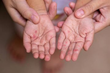 4 Langkah Mencegah Flu Singapura, Infeksi yang Banyak Menyerang Anak-anak