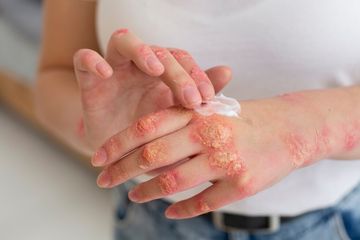 Apa itu Psoriasis? Simak Beberapa Gejala dan Cara Mengatasinya