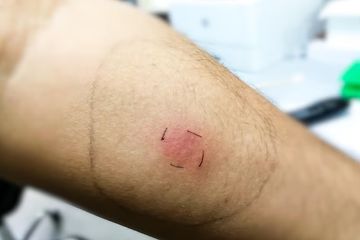 Benjolan di tempat suntikan tes Mantoux, menjadi petunjuk risiko TBC.