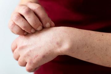 Cara mengatasi alergi dingin tanpa obat