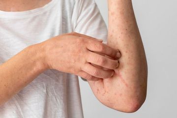 Kementerian Kesehatan memberikan beberapa tips mencegah penularan Mpox