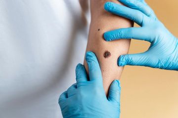 Kementerian Kesehatan akan Berikan Vaksin Mpox, Siapa Sasarannya?