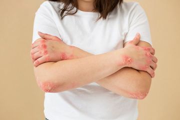 Penyakit Mpox Berstatus Darurat Global, Kemenkes Wanti-wanti Masyarakat yang Pergi ke Luar Negeri